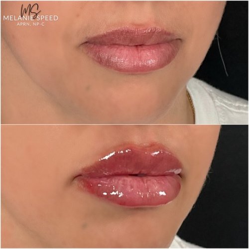 Lip Augmentation by Flawless Medspa