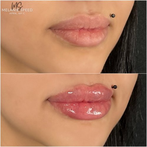 Lip Augmentation by Flawless Medspa