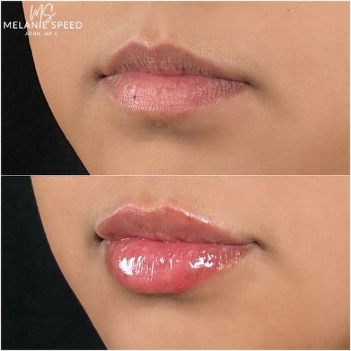 Lip Augmentation by Flawless Medspa