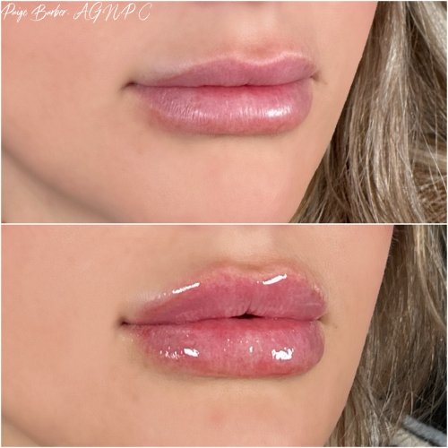 Lip Augmentation by Flawless Medspa