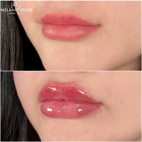 Lip Augmentation by Flawless Medspa