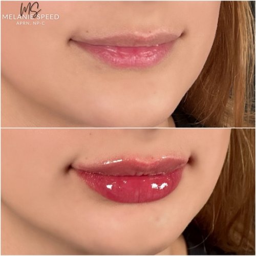 Lip Augmentation by Flawless Medspa