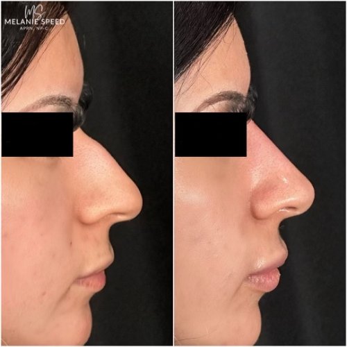 Nose Correction by Flawless Medspa