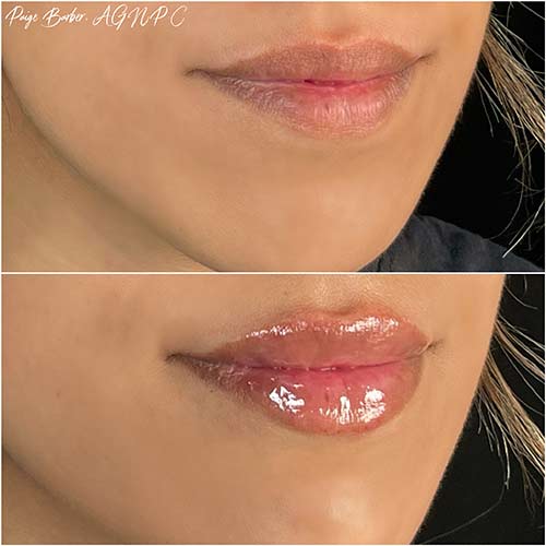Lip Augmentation Before & After Photos by Flawless MedSpa & The Beverly Hills MedSpa in Beverly Hills, CA and Las Vegas, NV