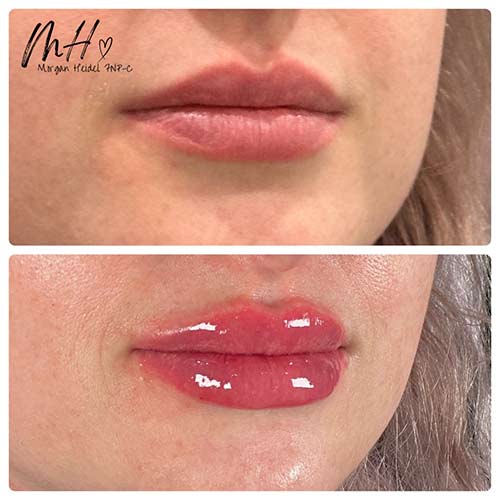 Lip Augmentation Before & After Photos by Flawless MedSpa & The Beverly Hills MedSpa in Beverly Hills, CA and Las Vegas, NV