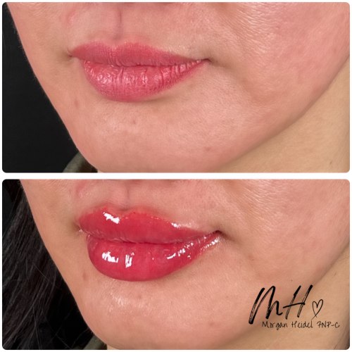 Lip Augmentation Before & After Photos by Flawless MedSpa & The Beverly Hills MedSpa in Beverly Hills, CA and Las Vegas, NV Lip Augmentation Before & After Photos by Flawless MedSpa & The Beverly Hills MedSpa in Beverly Hills, CA and Las Vegas, NV
