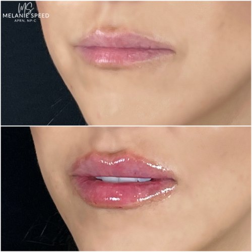 Lip Augmentation Before & After Photos by Flawless MedSpa & The Beverly Hills MedSpa in Beverly Hills, CA and Las Vegas, NV Lip Augmentation Before & After Photos by Flawless MedSpa & The Beverly Hills MedSpa in Beverly Hills, CA and Las Vegas, NV