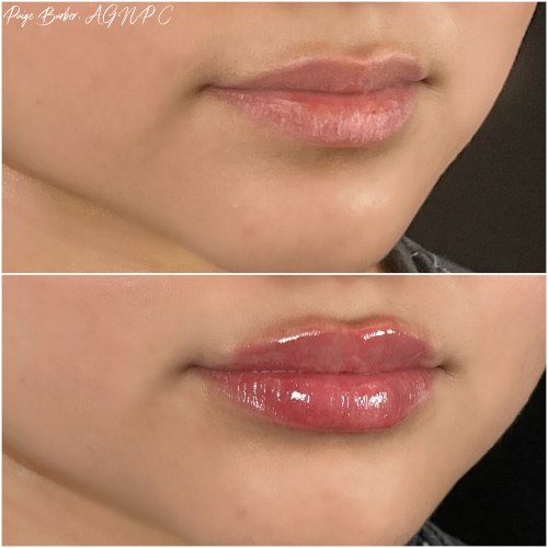 Lip Augmentation Before & After Photos by Flawless MedSpa & The Beverly Hills MedSpa in Beverly Hills, CA and Las Vegas, NV Lip Augmentation Before & After Photos by Flawless MedSpa & The Beverly Hills MedSpa in Beverly Hills, CA and Las Vegas, NV