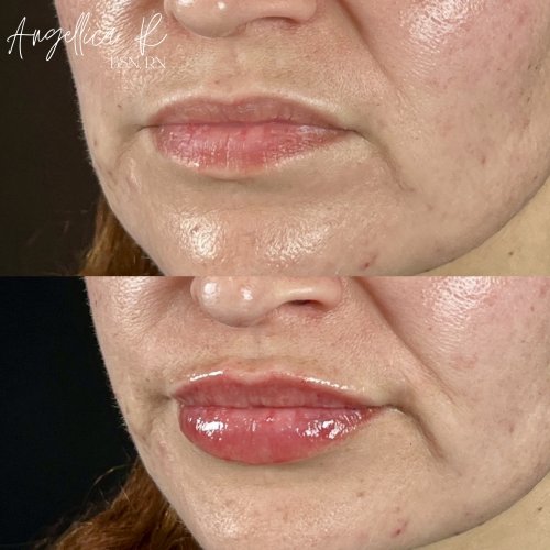 Lip Augmentation Before & After Photos by Flawless MedSpa & The Beverly Hills MedSpa in Beverly Hills, CA and Las Vegas, NV Lip Augmentation Before & After Photos by Flawless MedSpa & The Beverly Hills MedSpa in Beverly Hills, CA and Las Vegas, NV
