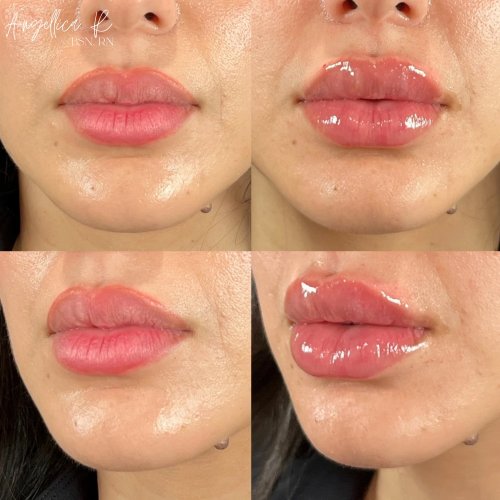 Lip Augmentation Before & After Photos by Flawless MedSpa & The Beverly Hills MedSpa in Beverly Hills, CA and Las Vegas, NV Lip Augmentation Before & After Photos by Flawless MedSpa & The Beverly Hills MedSpa in Beverly Hills, CA and Las Vegas, NV