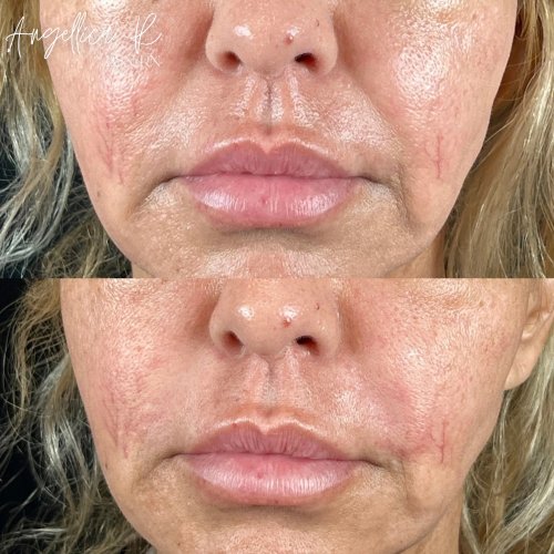 Lip Augmentation Before & After Photos by Flawless MedSpa & The Beverly Hills MedSpa in Beverly Hills, CA and Las Vegas, NV Lip Augmentation Before & After Photos by Flawless MedSpa & The Beverly Hills MedSpa in Beverly Hills, CA and Las Vegas, NV