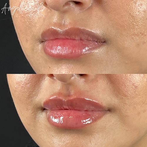 Lip Augmentation Before & After Photos by Flawless MedSpa & The Beverly Hills MedSpa in Beverly Hills, CA and Las Vegas, NV