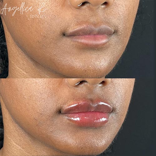 Lip Augmentation Before & After Photos by Flawless MedSpa & The Beverly Hills MedSpa in Beverly Hills, CA and Las Vegas, NV