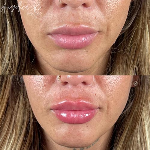 Lip Augmentation Before & After Photos by Flawless MedSpa & The Beverly Hills MedSpa in Beverly Hills, CA and Las Vegas, NV