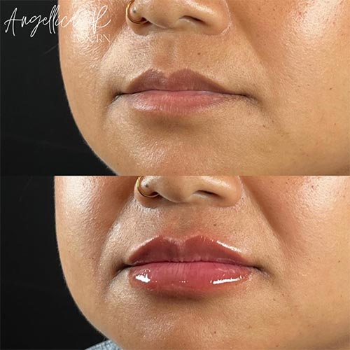 Lip Augmentation Before & After Photos by Flawless MedSpa & The Beverly Hills MedSpa in Beverly Hills, CA and Las Vegas, NV