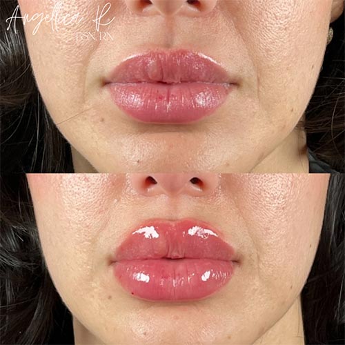 Lip Augmentation Before & After Photos by Flawless MedSpa & The Beverly Hills MedSpa in Beverly Hills, CA and Las Vegas, NV
