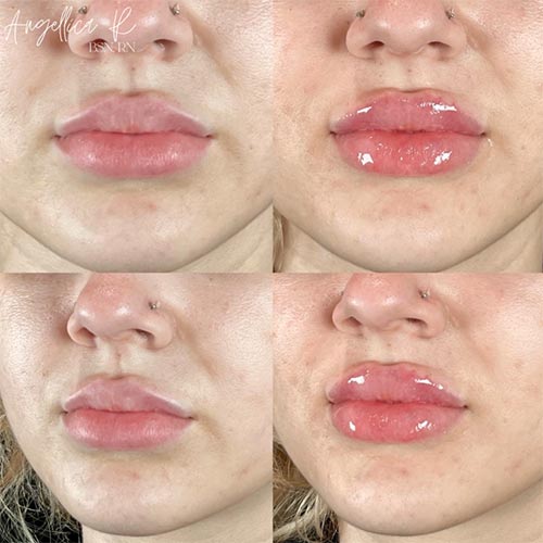 Lip Augmentation Before & After Photos by Flawless MedSpa & The Beverly Hills MedSpa in Beverly Hills, CA and Las Vegas, NV