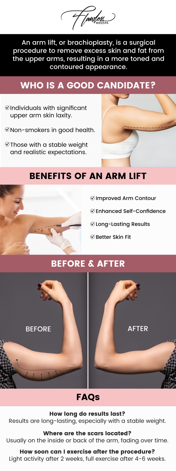Common questions asked by clients: What is a non‑surgical arm lift? Who is a good candidate for a non‑surgical arm lift? How long do the results of a non‑surgical arm lift last? How many sessions are needed of non‑surgical arm lift?
Non-surgical arm lift treatments, offered by Melanie Speed, APRN, NP-C, CANS, at Flawless MedSpa & The Beverly Hills MedSpa, help reduce arm fat and tighten loose skin. Using advanced technologies these treatments provide natural, toned results with minimal downtime. Achieve sculpted, youthful arms without the need for surgery. For more information, please contact us or schedule an appointment online. We have convenient locations to serve you in Las Vegas, NV and Beverly Hills, CA. We serve clients from Las Vegas NV, Summerlin South NV, Paradise NV, Winchester NV, Beverly Hills CA, Los Angeles CA, Santa Monica CA, Burbank CA, and surrounding areas.