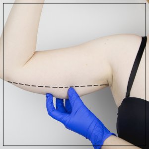 Arm Lift Near Me in Beverly Hills, CA and Las Vegas, NV