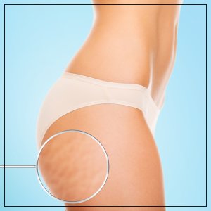 Cellulite Reduction Near Me in Beverly Hills, CA and Las Vegas, NV