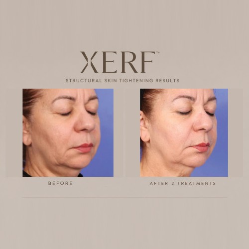 XERF Skin Before And After Tightening in Beverly Hills, CA XERF Skin Before And After Tightening in Beverly Hills, CA