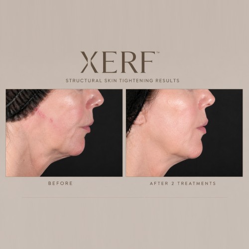 XERF Skin Before And After Tightening in Beverly Hills, CA XERF Skin Before And After Tightening in Beverly Hills, CA