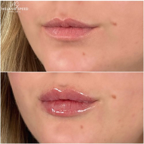 Lip Augmentation Before & After Photos by Flawless MedSpa & The Beverly Hills MedSpa in Beverly Hills, CA and Las Vegas, NV