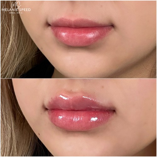 Lip Augmentation Before & After Photos by Flawless MedSpa & The Beverly Hills MedSpa in Beverly Hills, CA and Las Vegas, NV