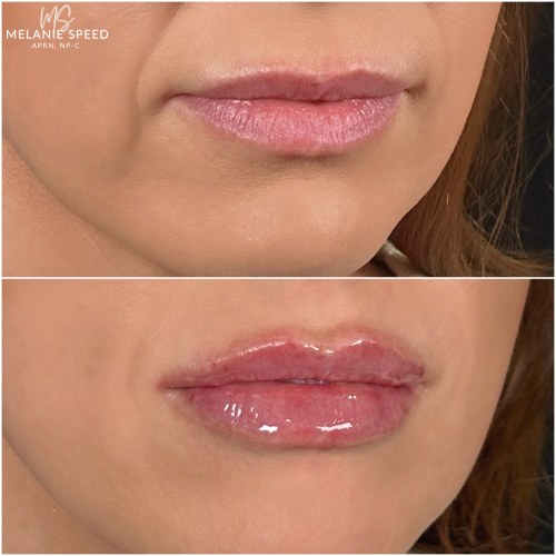Lip Augmentation Before & After Photos by Flawless MedSpa & The Beverly Hills MedSpa in Beverly Hills, CA and Las Vegas, NV