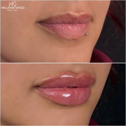 Lip Augmentation Before & After Photos by Flawless MedSpa & The Beverly Hills MedSpa in Beverly Hills, CA and Las Vegas, NV
