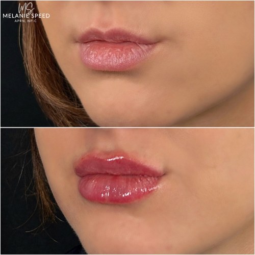 Lip Augmentation Before & After Photos by Flawless MedSpa & The Beverly Hills MedSpa in Beverly Hills, CA and Las Vegas, NV