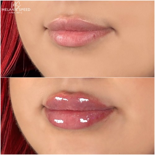 Lip Augmentation Before & After Photos by Flawless MedSpa & The Beverly Hills MedSpa in Beverly Hills, CA and Las Vegas, NV