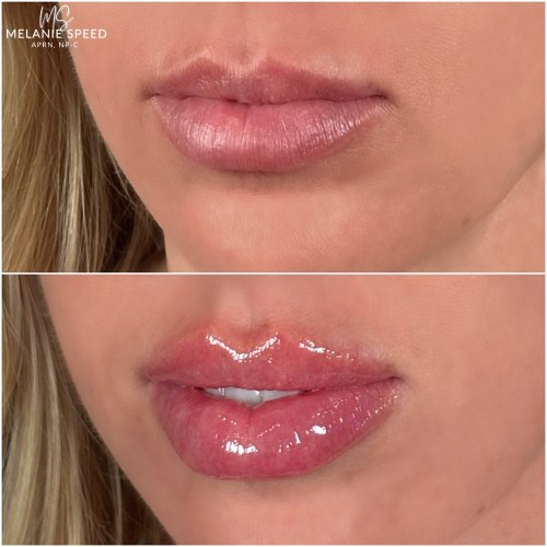 Lip Augmentation Before & After Photos by Flawless MedSpa & The Beverly Hills MedSpa in Beverly Hills, CA and Las Vegas, NV