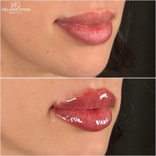 Lip Augmentation Before & After Photos by Flawless MedSpa & The Beverly Hills MedSpa in Beverly Hills, CA and Las Vegas, NV