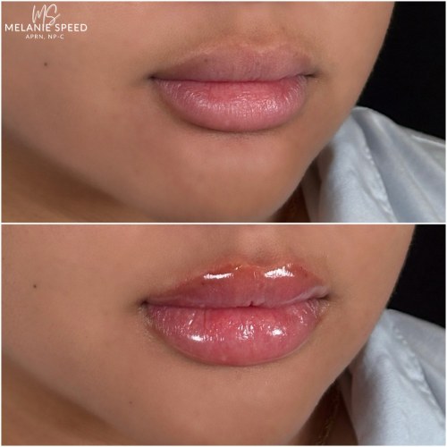 Lip Augmentation Before & After Photos by Flawless MedSpa & The Beverly Hills MedSpa in Beverly Hills, CA and Las Vegas, NV