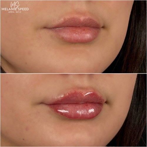 Lip Augmentation Before & After Photos by Flawless MedSpa & The Beverly Hills MedSpa in Beverly Hills, CA and Las Vegas, NV