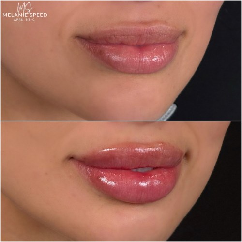 Lip Augmentation Before & After Photos by Flawless MedSpa & The Beverly Hills MedSpa in Beverly Hills, CA and Las Vegas, NV
