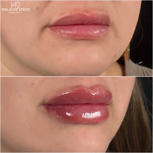 Lip Augmentation Before & After Photos by Flawless MedSpa & The Beverly Hills MedSpa in Beverly Hills, CA and Las Vegas, NV