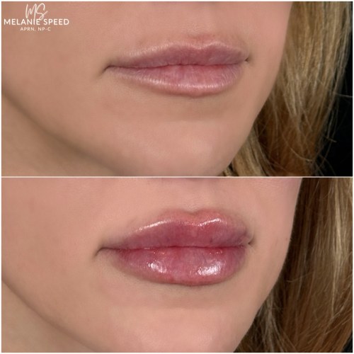 Lip Augmentation Before & After Photos by Flawless MedSpa & The Beverly Hills MedSpa in Beverly Hills, CA and Las Vegas, NV