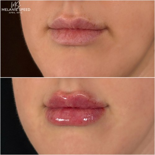 Lip Augmentation Before & After Photos by Flawless MedSpa & The Beverly Hills MedSpa in Beverly Hills, CA and Las Vegas, NV