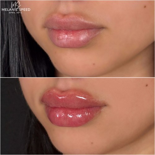 Lip Augmentation Before & After Photos by Flawless MedSpa & The Beverly Hills MedSpa in Beverly Hills, CA and Las Vegas, NV