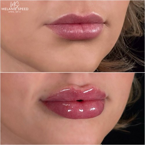 Lip Augmentation Before & After Photos by Flawless MedSpa & The Beverly Hills MedSpa in Beverly Hills, CA and Las Vegas, NV