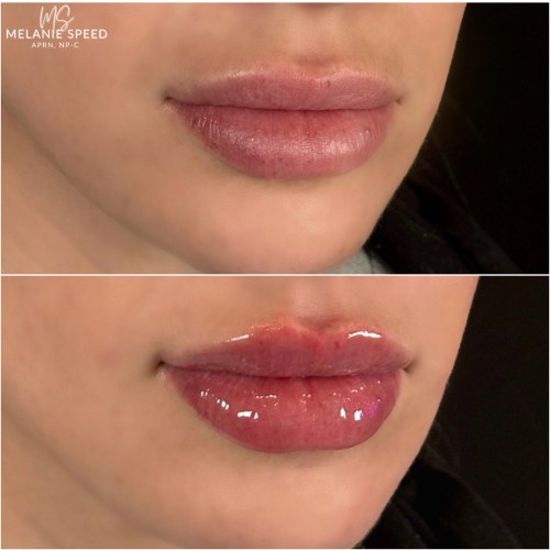 Lip Augmentation Before & After Photos by Flawless MedSpa & The Beverly Hills MedSpa in Beverly Hills, CA and Las Vegas, NV