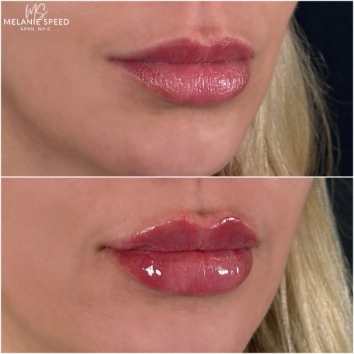 Lip Augmentation Before & After Photos by Flawless MedSpa & The Beverly Hills MedSpa in Beverly Hills, CA and Las Vegas, NV