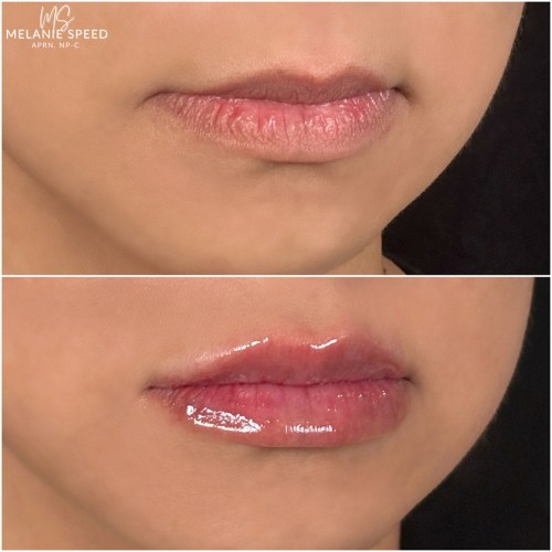 Lip Augmentation Before & After Photos by Flawless MedSpa & The Beverly Hills MedSpa in Beverly Hills, CA and Las Vegas, NV