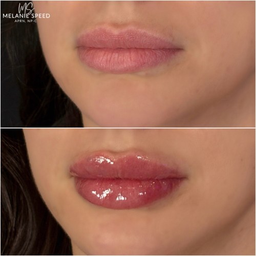 Lip Augmentation Before & After Photos by Flawless MedSpa & The Beverly Hills MedSpa in Beverly Hills, CA and Las Vegas, NV