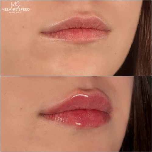 Lip Augmentation Before & After Photos by Flawless MedSpa & The Beverly Hills MedSpa in Beverly Hills, CA and Las Vegas, NV