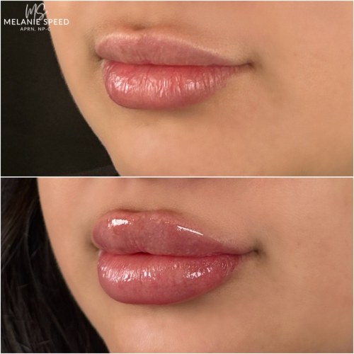 Lip Augmentation Before & After Photos by Flawless MedSpa & The Beverly Hills MedSpa in Beverly Hills, CA and Las Vegas, NV