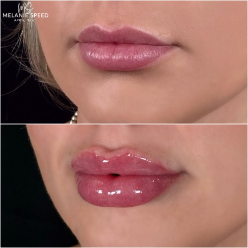 Lip Augmentation Before & After Photos by Flawless MedSpa & The Beverly Hills MedSpa in Beverly Hills, CA and Las Vegas, NV