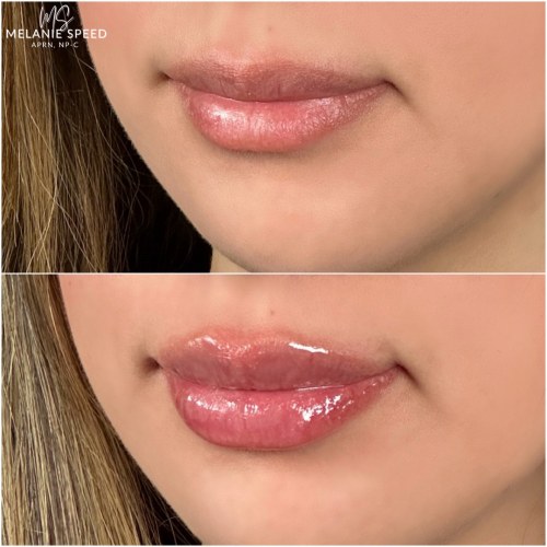 Lip Augmentation Before & After Photos by Flawless MedSpa & The Beverly Hills MedSpa in Beverly Hills, CA and Las Vegas, NV